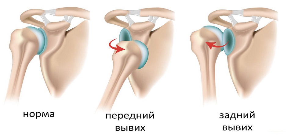 Механизм щелка при вывихе плечевого сустава