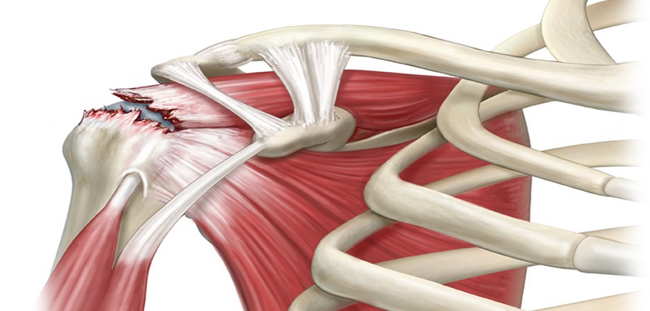 Схема повреждения сухожилий подостной и надостной мышц плеча