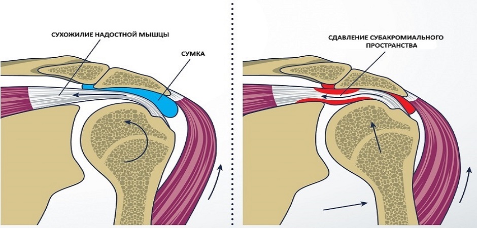 Импиджмент синдром плечевого сустава. Схема