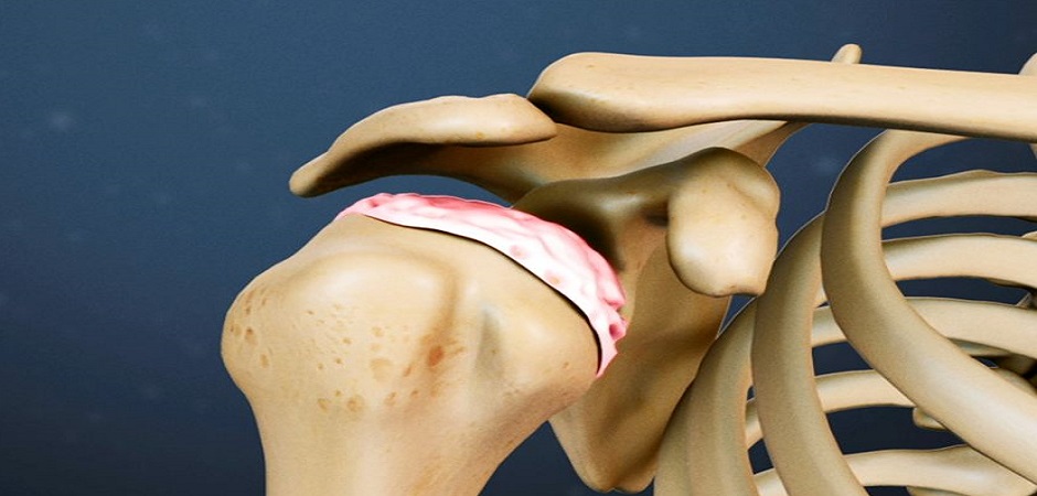 Анатомическая схема артроза 1 степени плечевого сустава