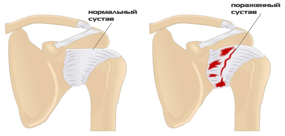 Анатомическая схема артроза 1 степени плечевого сустава