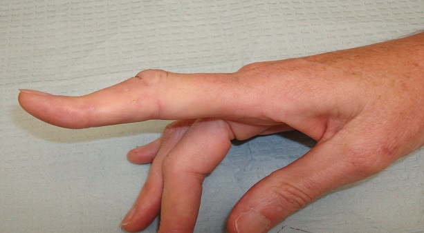 Разрыв сухожилия на пальце