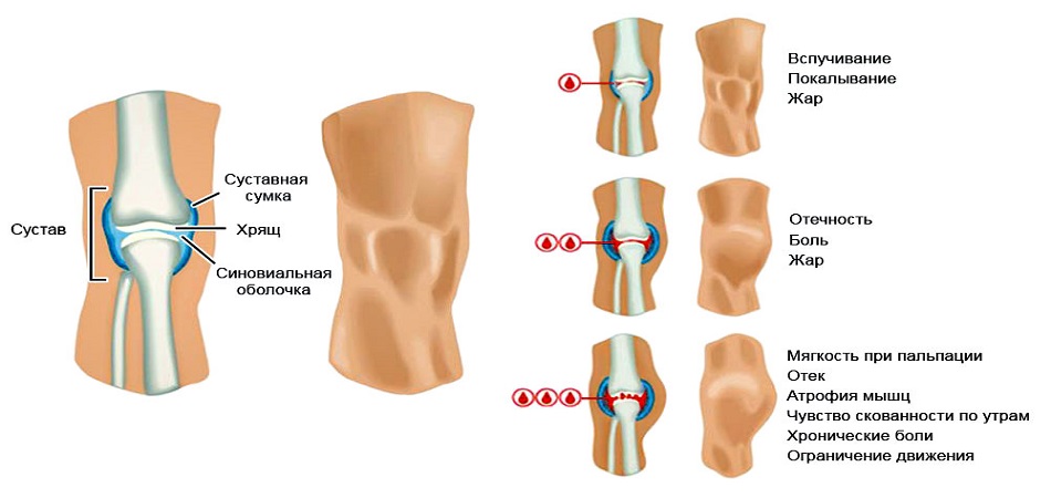Схема развития гемартроза коленного сустава