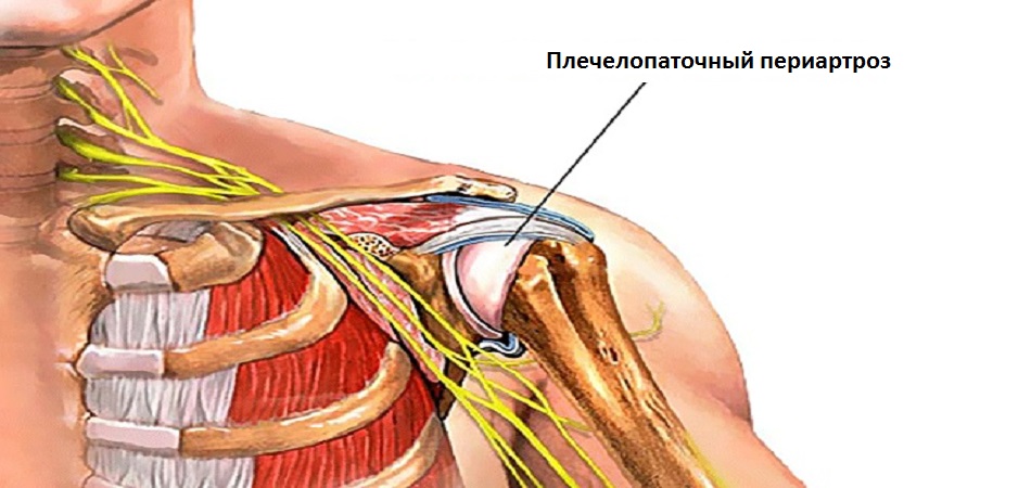 Схема периартроза плеча