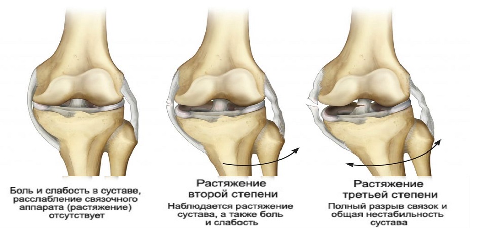 Признаки растяжения связок колена