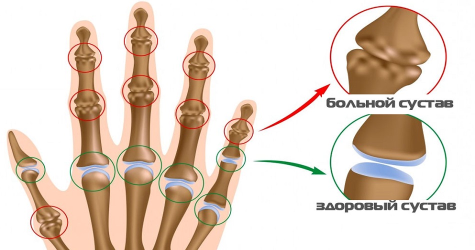 Сустав большого пальца руки. Артроз пястно-фалангового сустава.