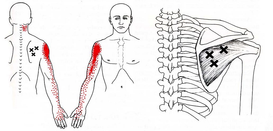 Иррадиация болей поясницы. Подостная мышца триггерные точки. Триггерные точки в грудной мышце. Подлопаточная мышца триггерные точки. Триггерные точки при миозите грудной клетки.