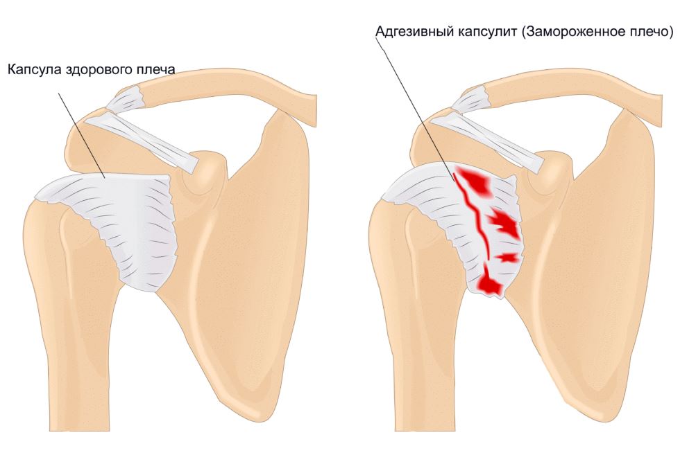 Лечение замороженного плеча
