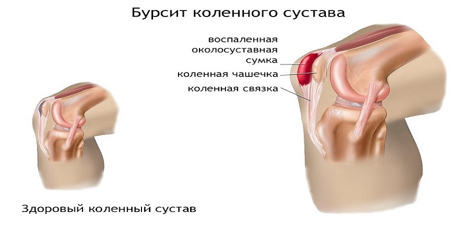 bol u donjem dijelu leđa s artrozom zgloba kuka
