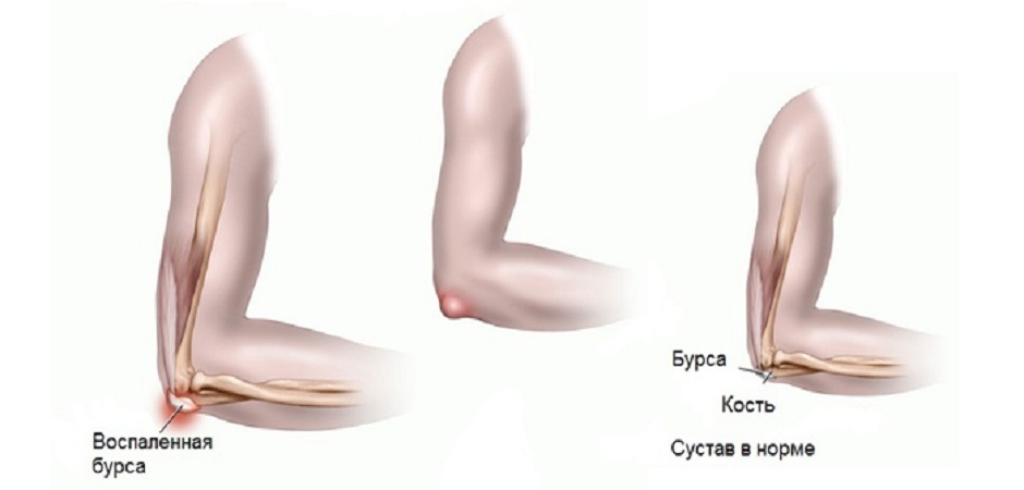 Лечение геморрагического бурсита
