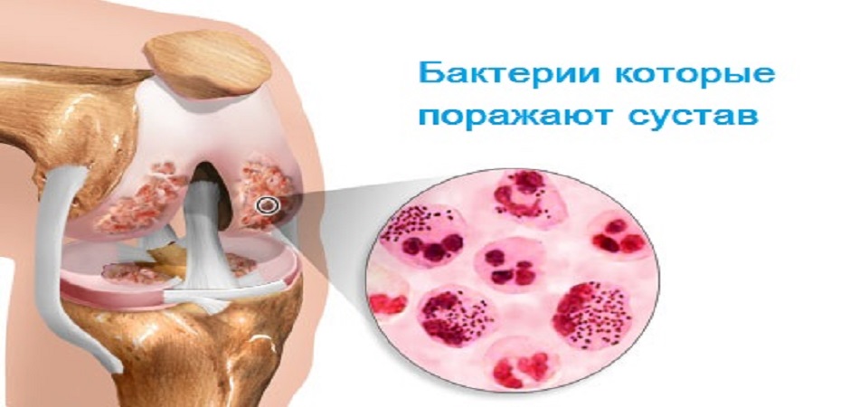 Лечение гонорейного артрита