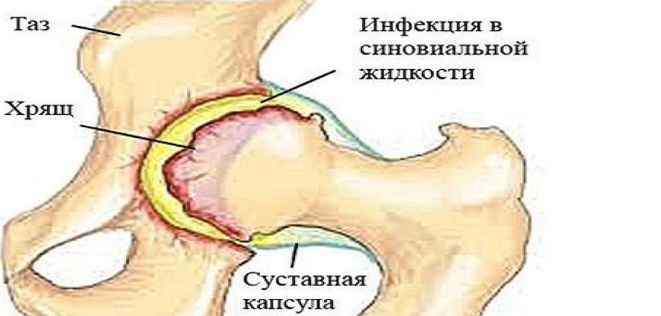 Лечение инфекционного синовита
