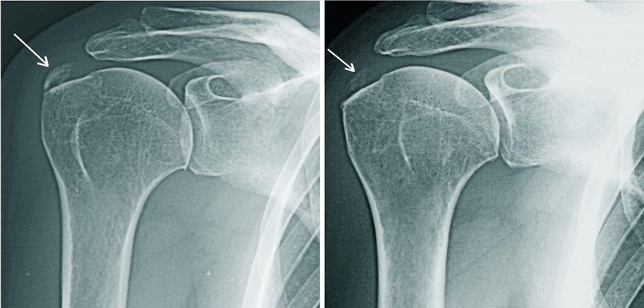 Рентген-признаки кальцифицирующего тендинита плечевого сустава