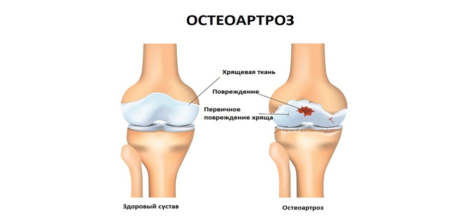Лечение посттравматического артроза (остеоартроза)