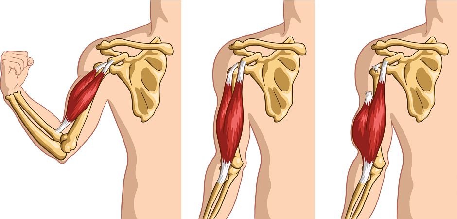 Схема разрыва плечевого сухожилия