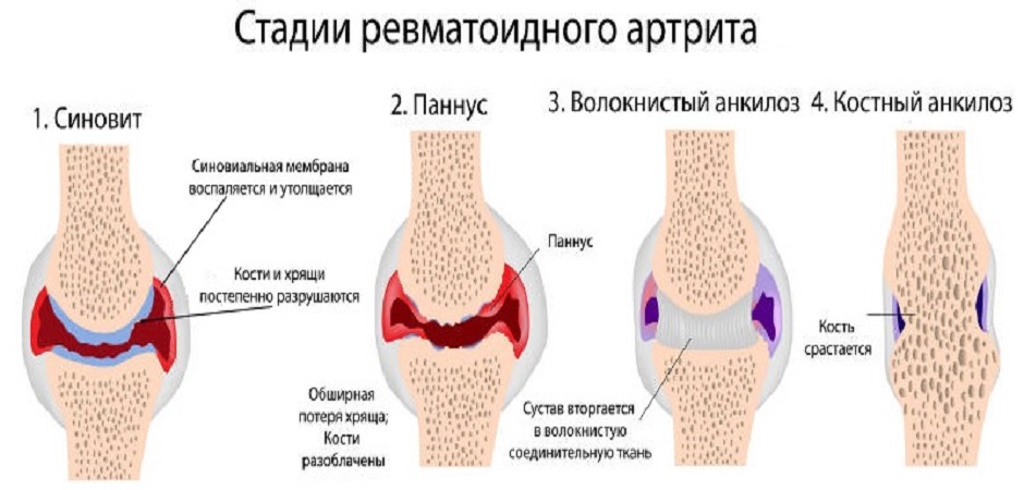 Лечение аллергического синовита