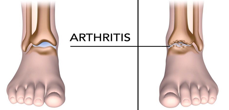 Лечение артрита ног 