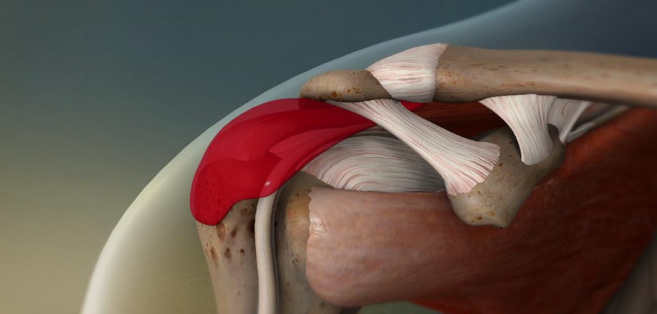 Схема подлопаточного бурсита плечевого сустава