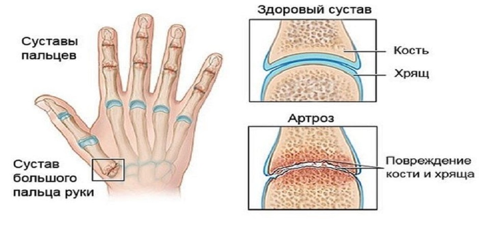 Лечение полиостеоартроза суставов в Москве