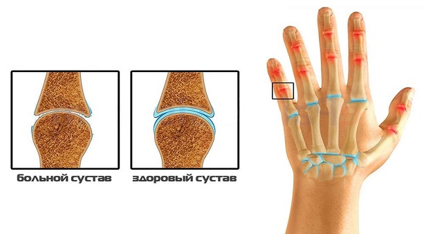 Лечение артрита большого пальца