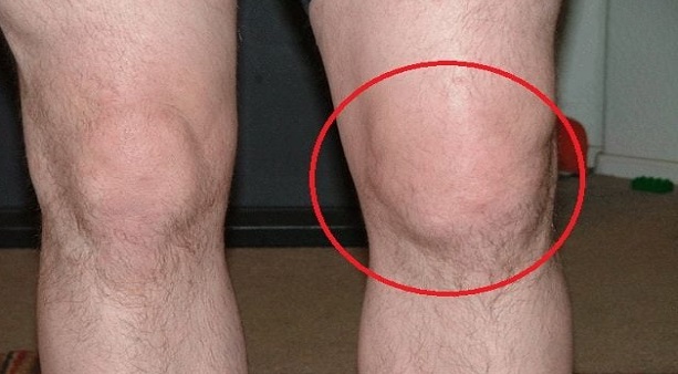 Мази и гели при боли в коленях