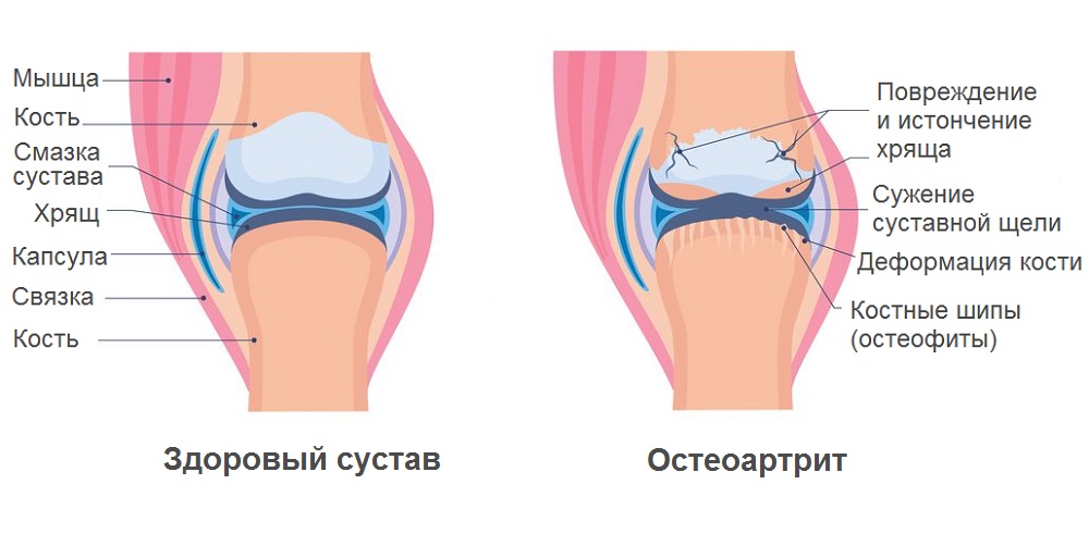 Zdoroviy sustav i osteoartrit.jpg
