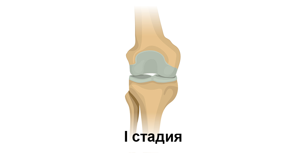 Osteoarthritis_Knee-1.jpg