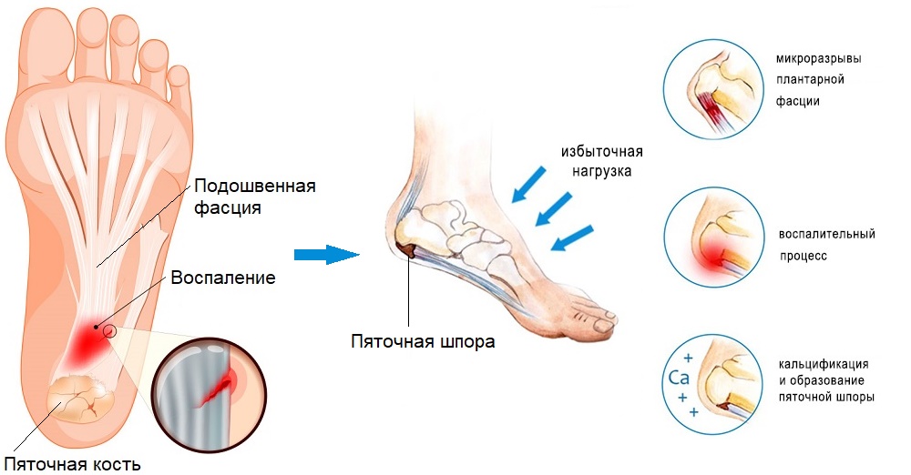 Пятка болит с внутренней стороны правой ноги: причины и способы лечения