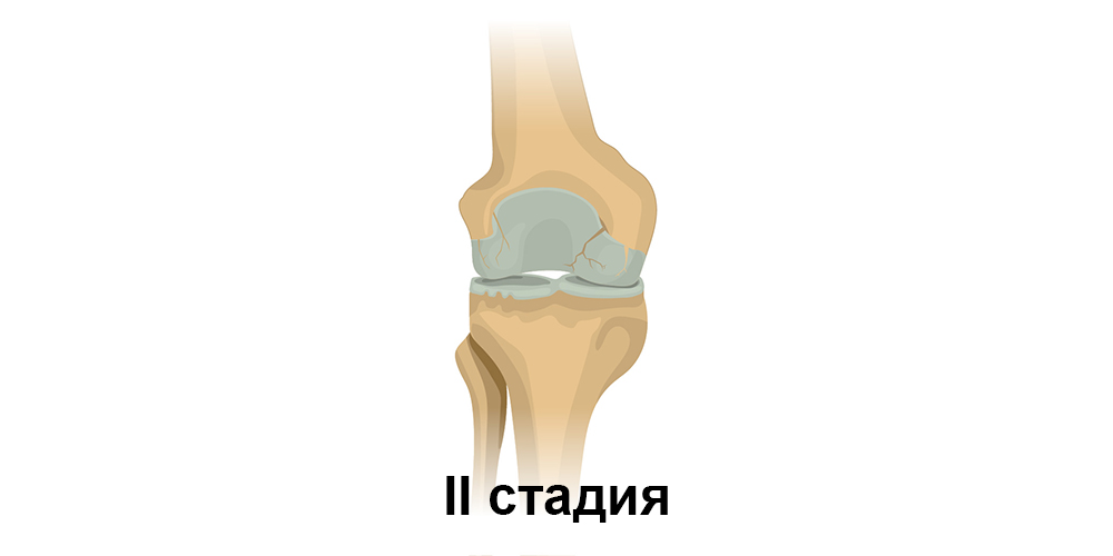 Osteoarthritis_Knee-2.jpg