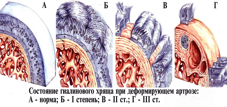  3 стадии артроза тазобедренного сустава