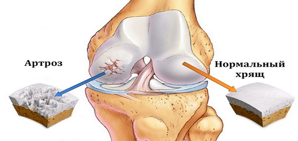 Диагностика артроза и лечение боли в колене