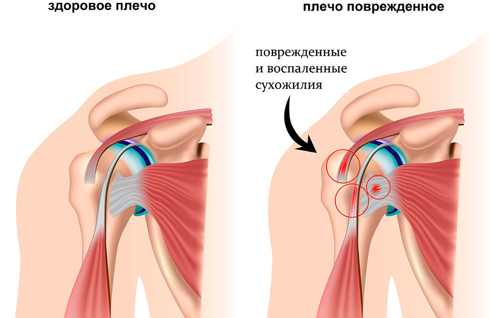 Анатомия бурситов плечевого сустава