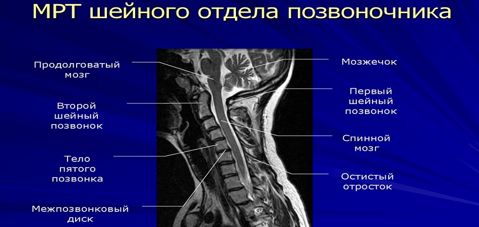МРТ шейного остеохондроза