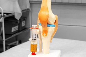 PRP-терапия коленного сустава